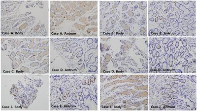 Mucosal distribution of somatostatin-secreting gastric Delta cells in children with gastrointestinal reflux diseases